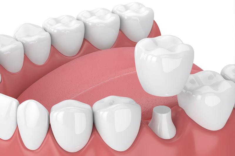 Dental Crowns in Cedar Rapids