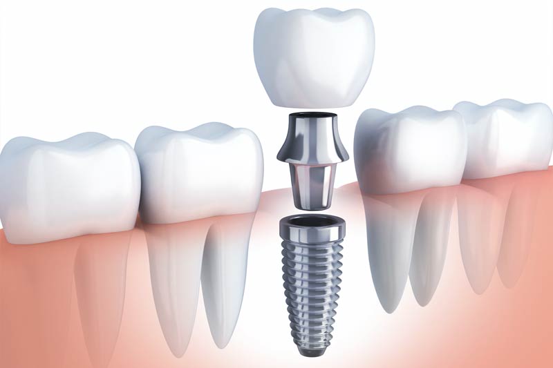 Implants Dentist in Cedar Rapids