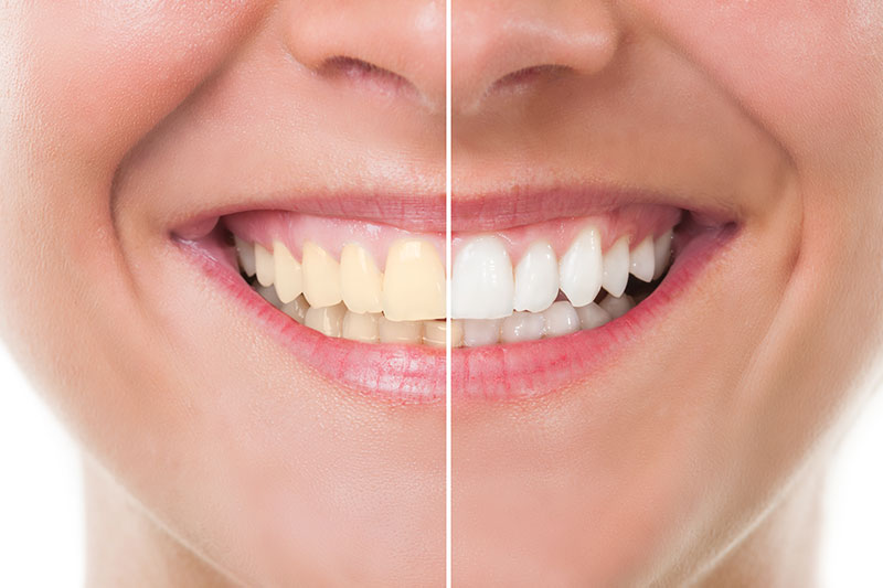 Teeth Whitening in Cedar Rapids